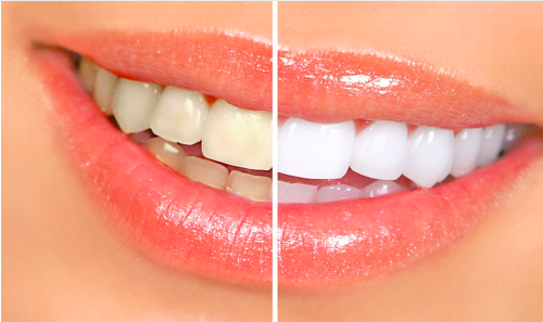 Natural activated charcoal teeth whitening